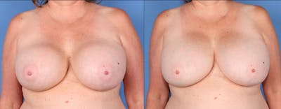 Breast Revision Before & After Gallery - Patient 152534889 - Image 1