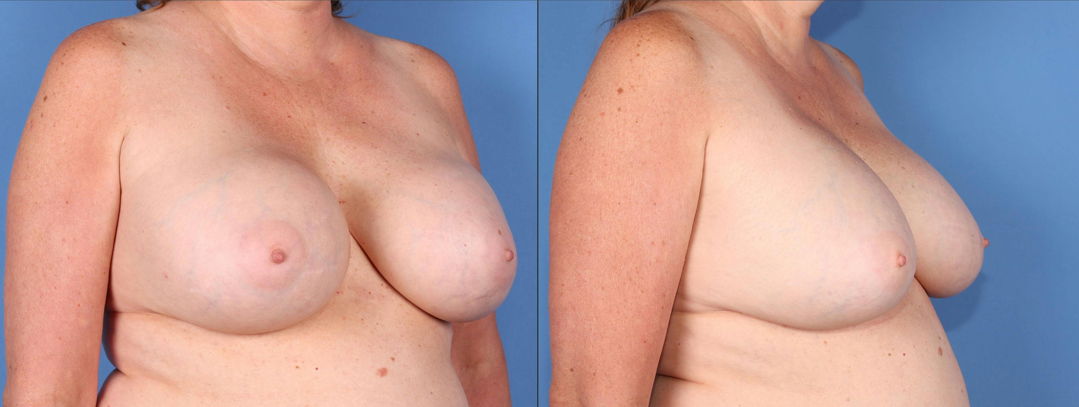Breast Implant Revision Before & After Gallery - Patient 152534889 - Image 2