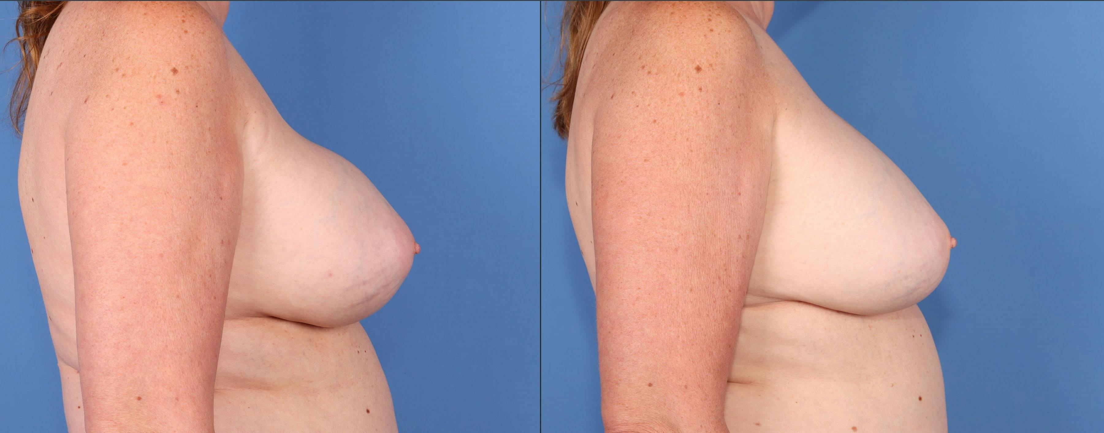 Breast Revision Before & After Gallery - Patient 152534889 - Image 3