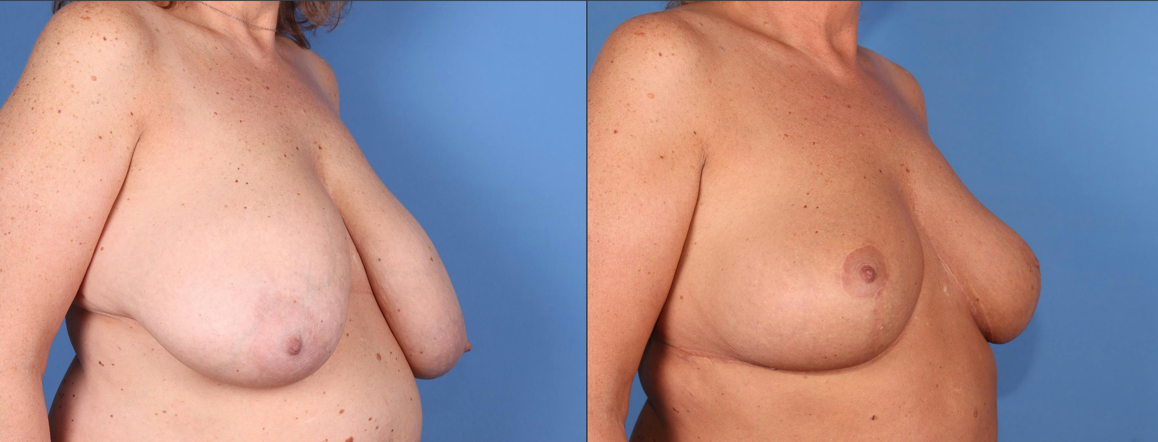 Breast Reduction Before & After Gallery - Patient 155746959 - Image 2