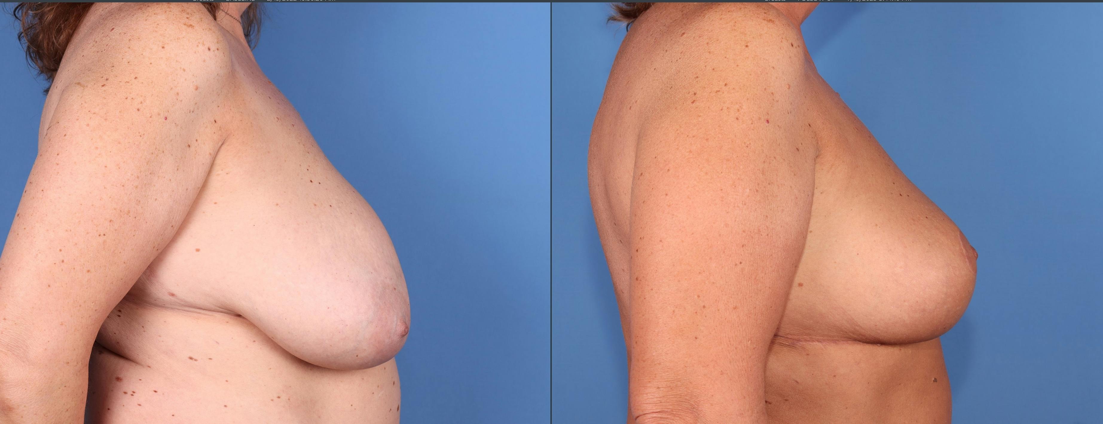 Breast Reduction Before & After Gallery - Patient 155746959 - Image 3