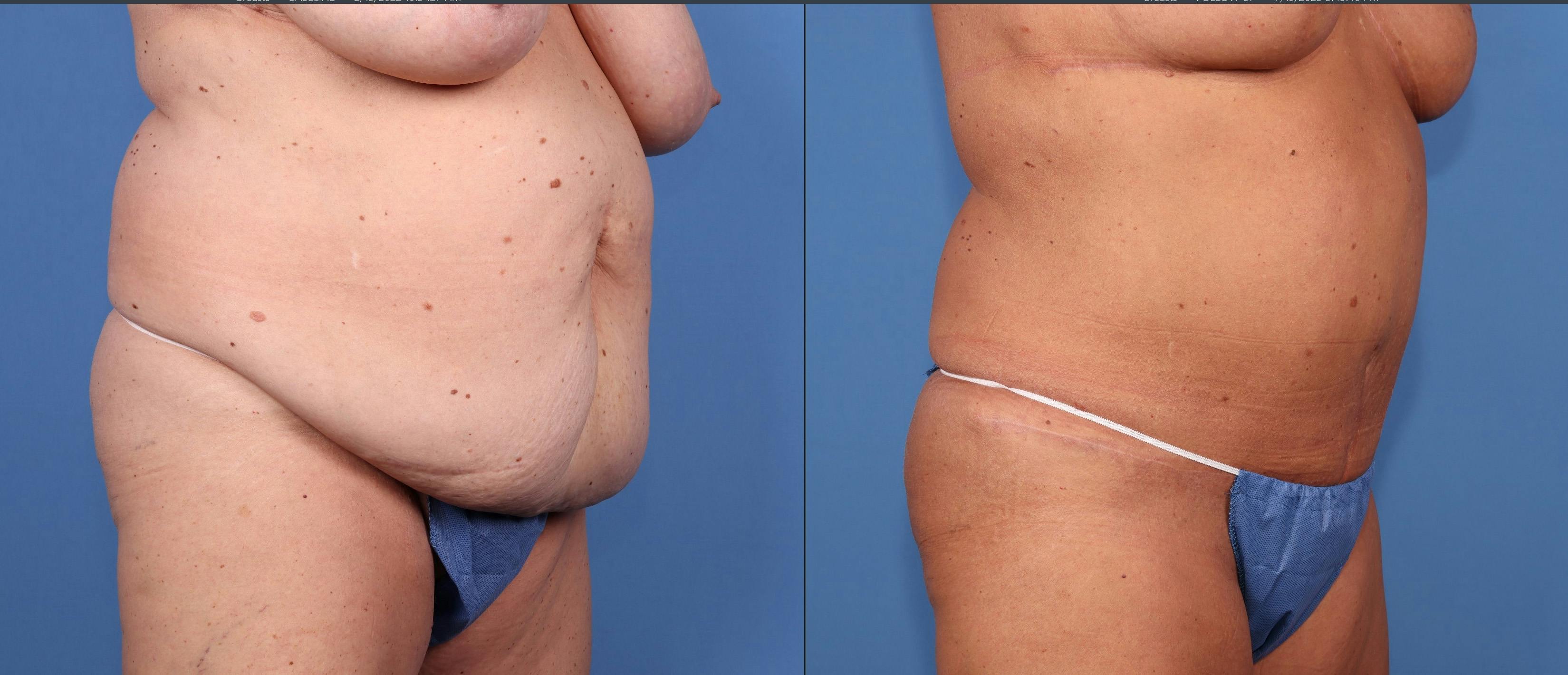 Tummy Tuck Before & After Gallery - Patient 155746964 - Image 2