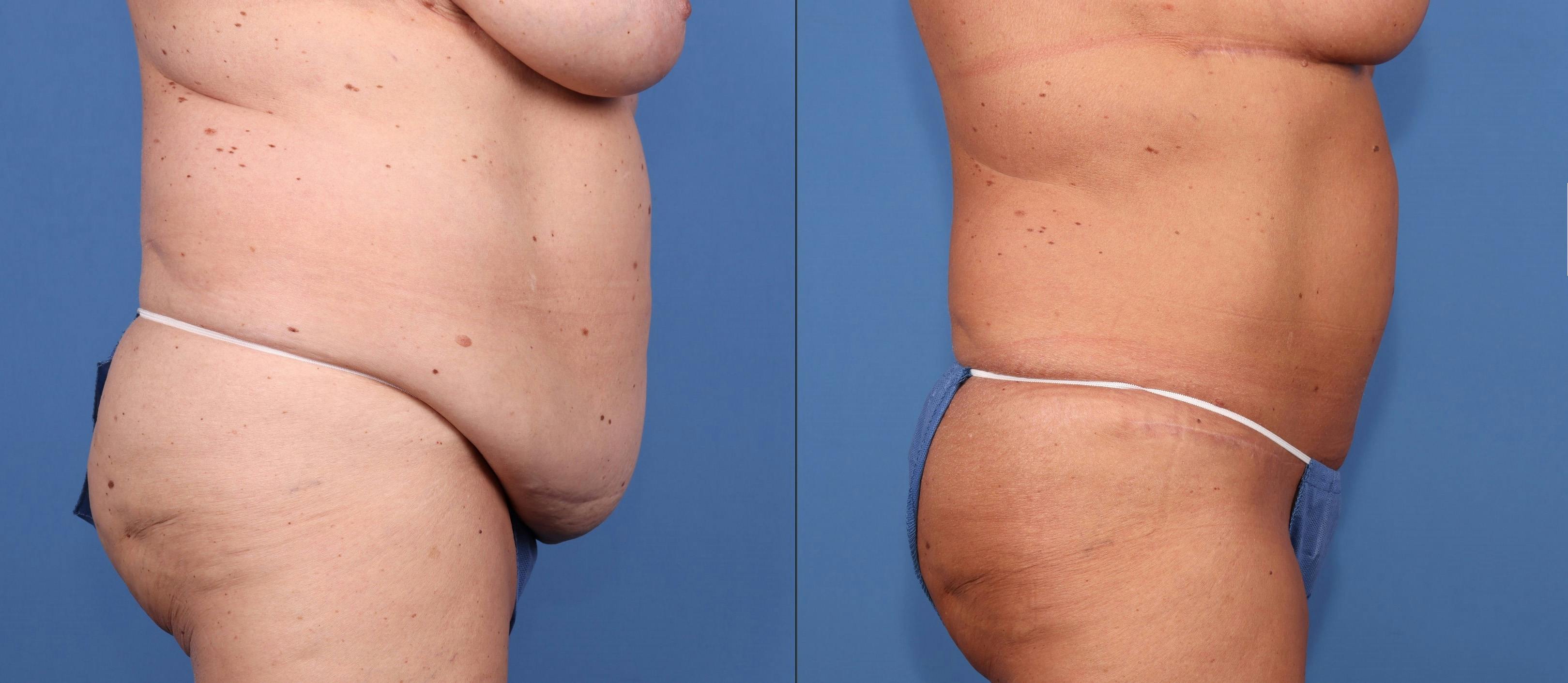 Tummy Tuck Before & After Gallery - Patient 155746964 - Image 3