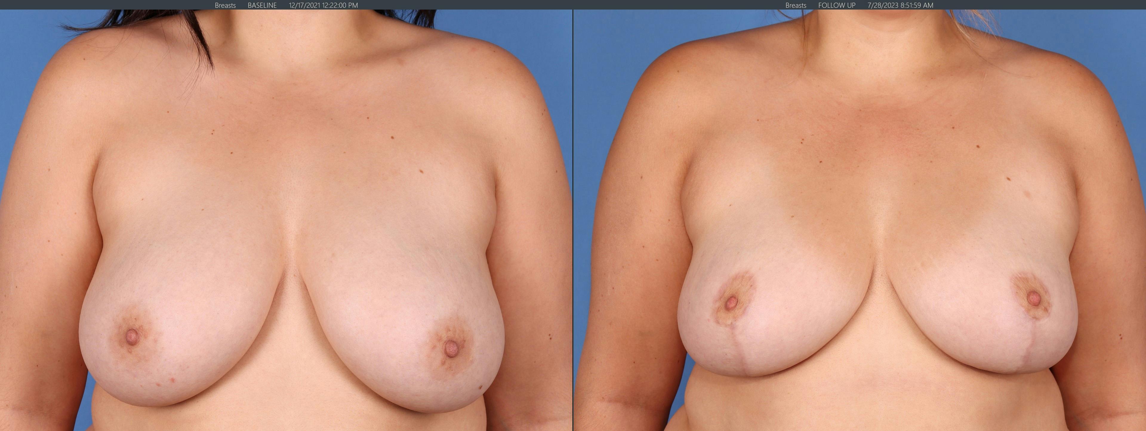 Breast Lift Before & After Gallery - Patient 157603100 - Image 1