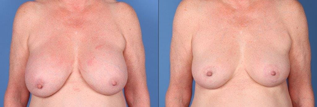 Breast Lift Before & After Gallery - Patient 159531087 - Image 1