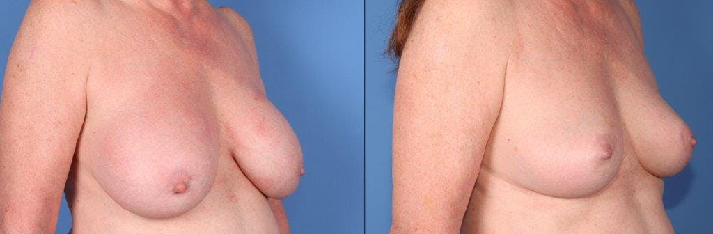 Breast Revision Before & After Gallery - Patient 159531089 - Image 2