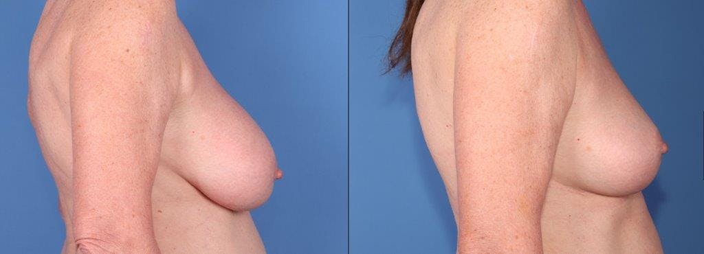 Breast Revision Before & After Gallery - Patient 159531089 - Image 3