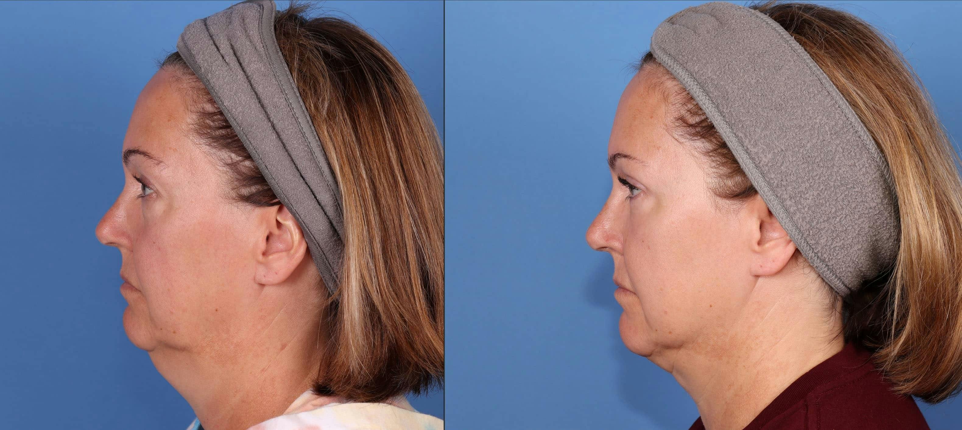 Eyelid Surgery (Blepharoplasty) Before & After Gallery - Patient 161578105 - Image 2