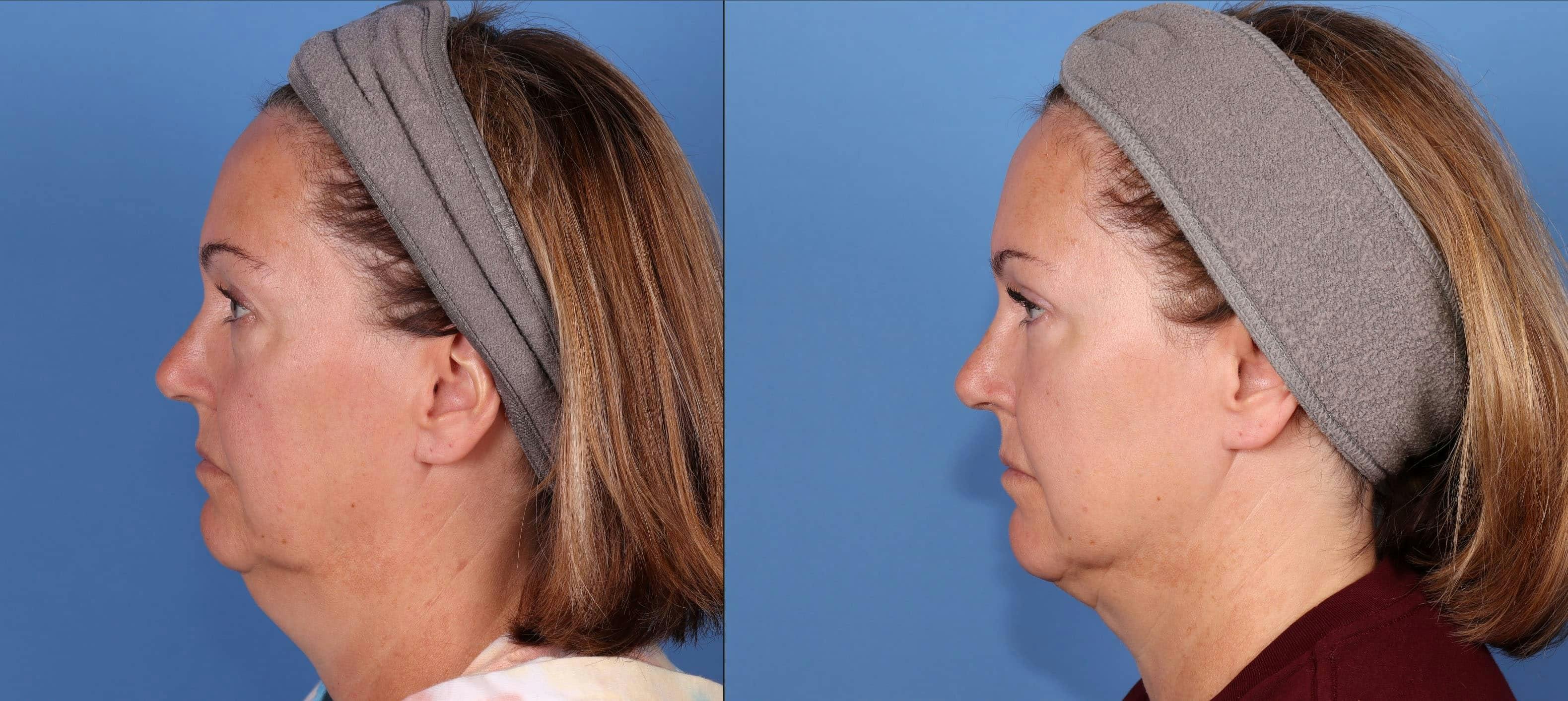 Fat Grafting Before & After Gallery - Patient 161578087 - Image 2