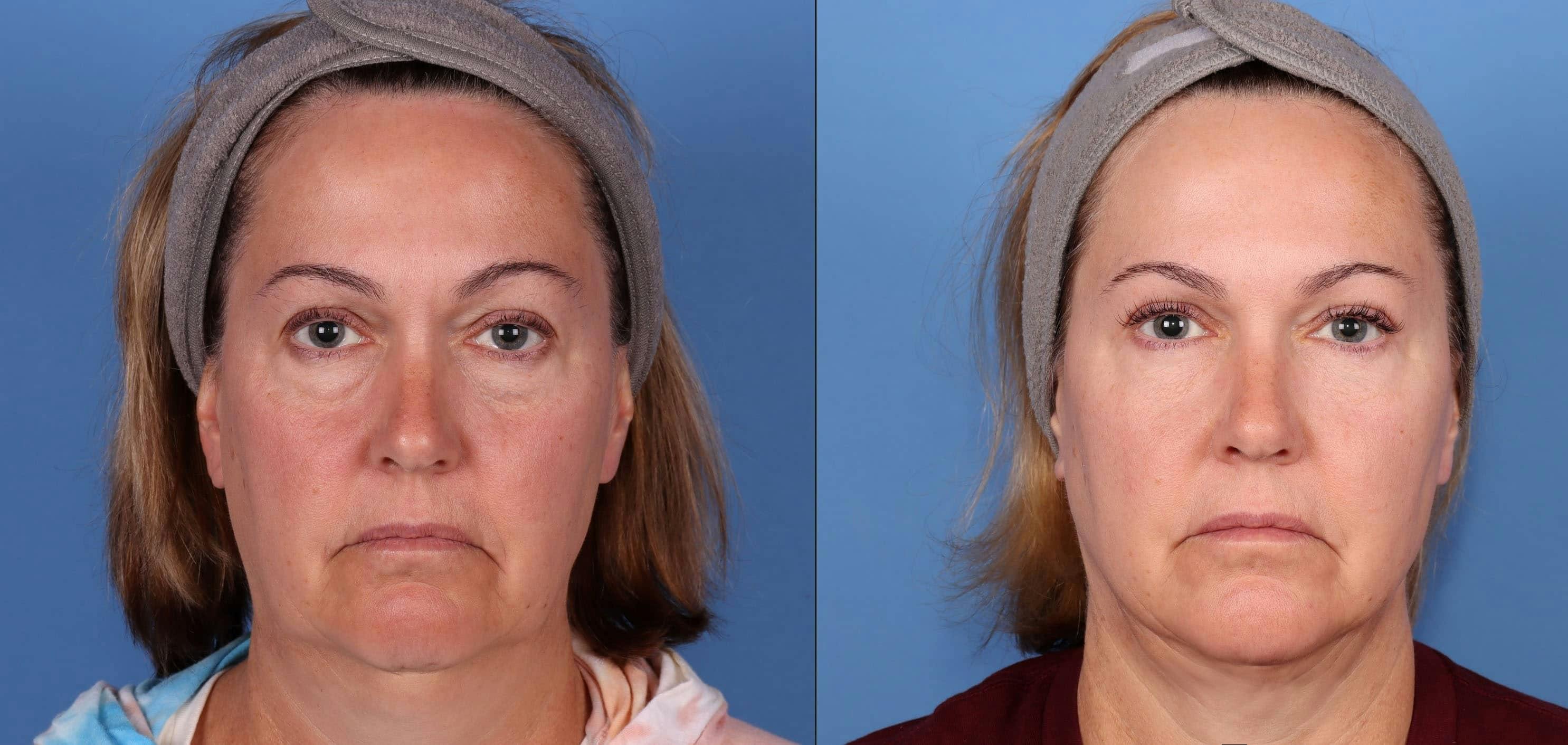 Eyelid Surgery (Blepharoplasty) Before & After Gallery - Patient 161578105 - Image 1