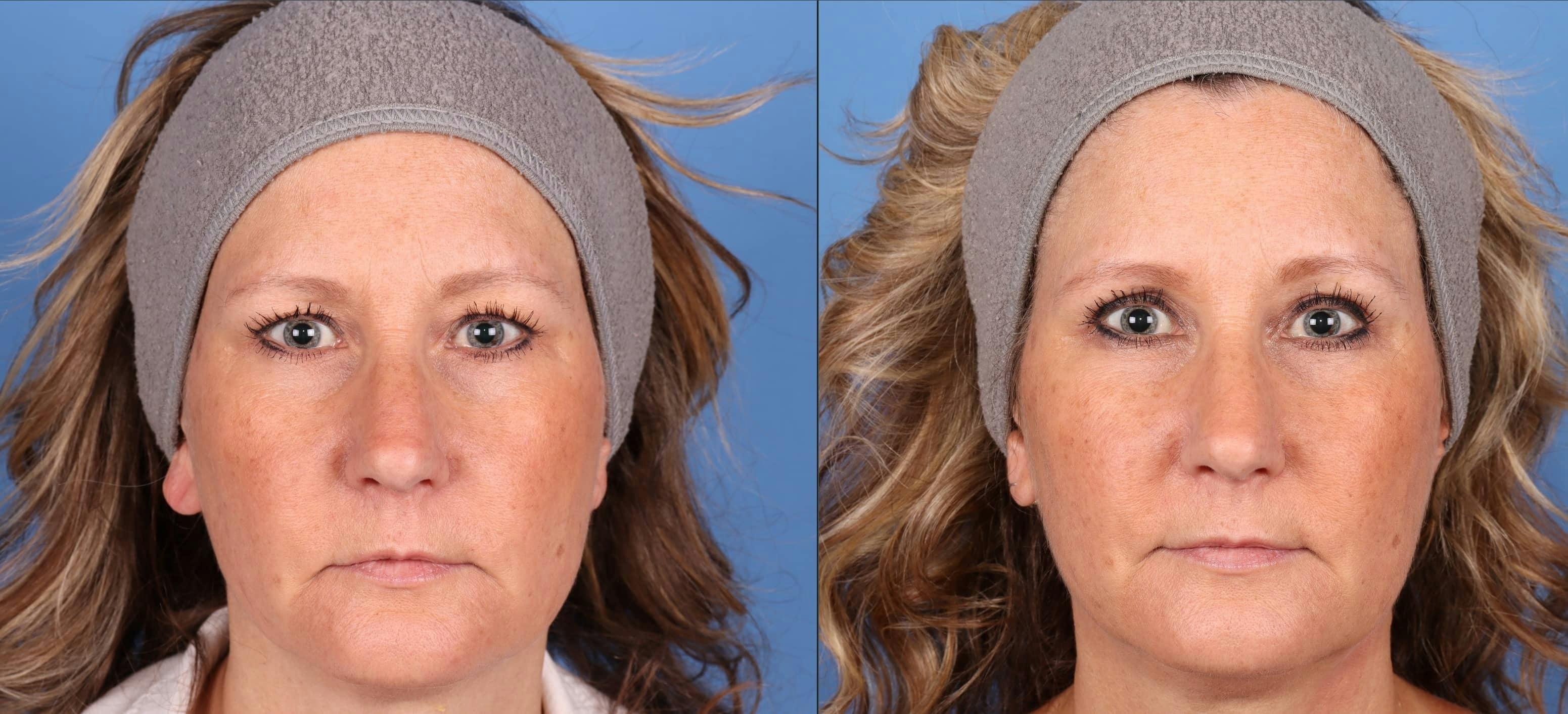 Eyelid Surgery (Upper Blepharoplasty) Before & After Gallery - Patient 162340777 - Image 1