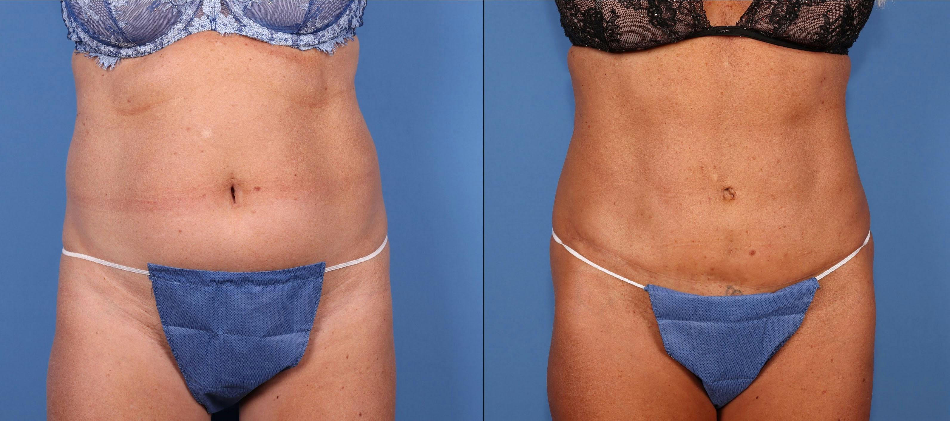 Tummy Tuck Before & After Gallery - Patient 164794742 - Image 1