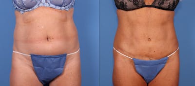 Tummy Tuck Before & After Gallery - Patient 164794742 - Image 1
