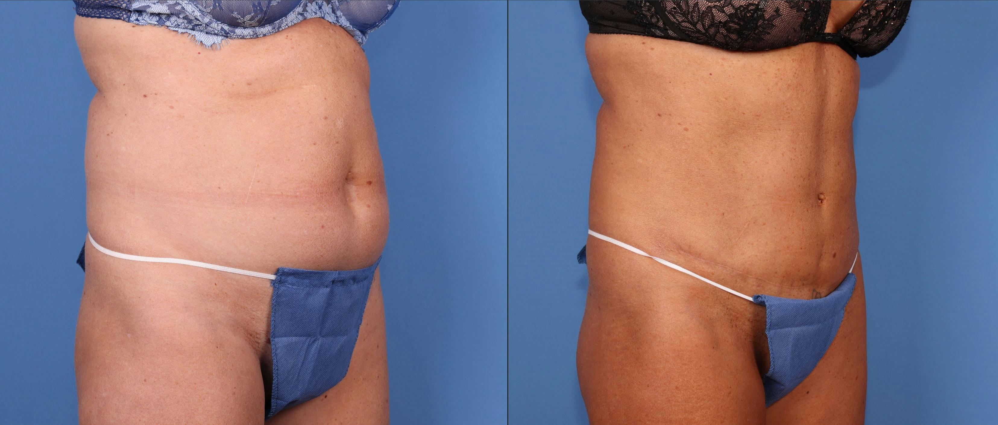 Tummy Tuck Before & After Gallery - Patient 164794742 - Image 2