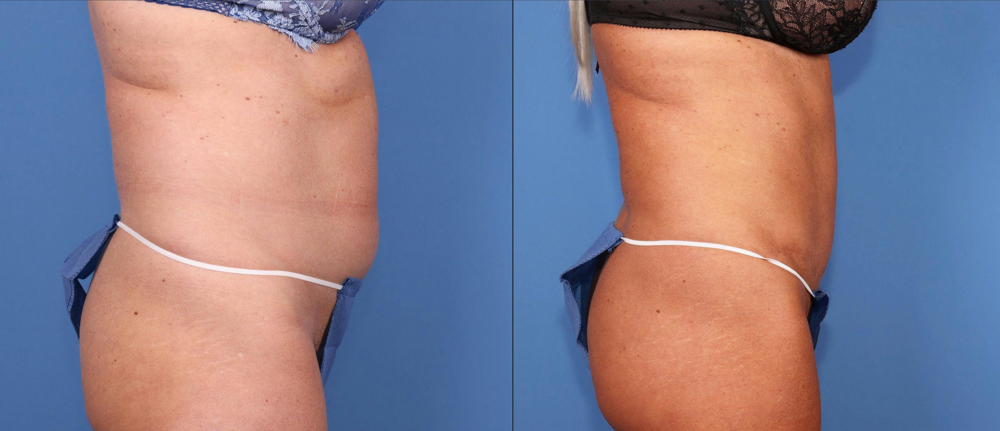 Tummy Tuck Before & After Gallery - Patient 164794742 - Image 3
