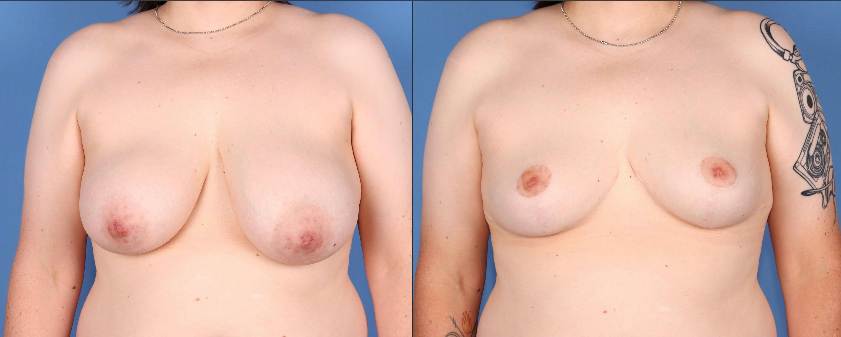 Breast Reduction Before & After Gallery - Patient 165467897 - Image 1