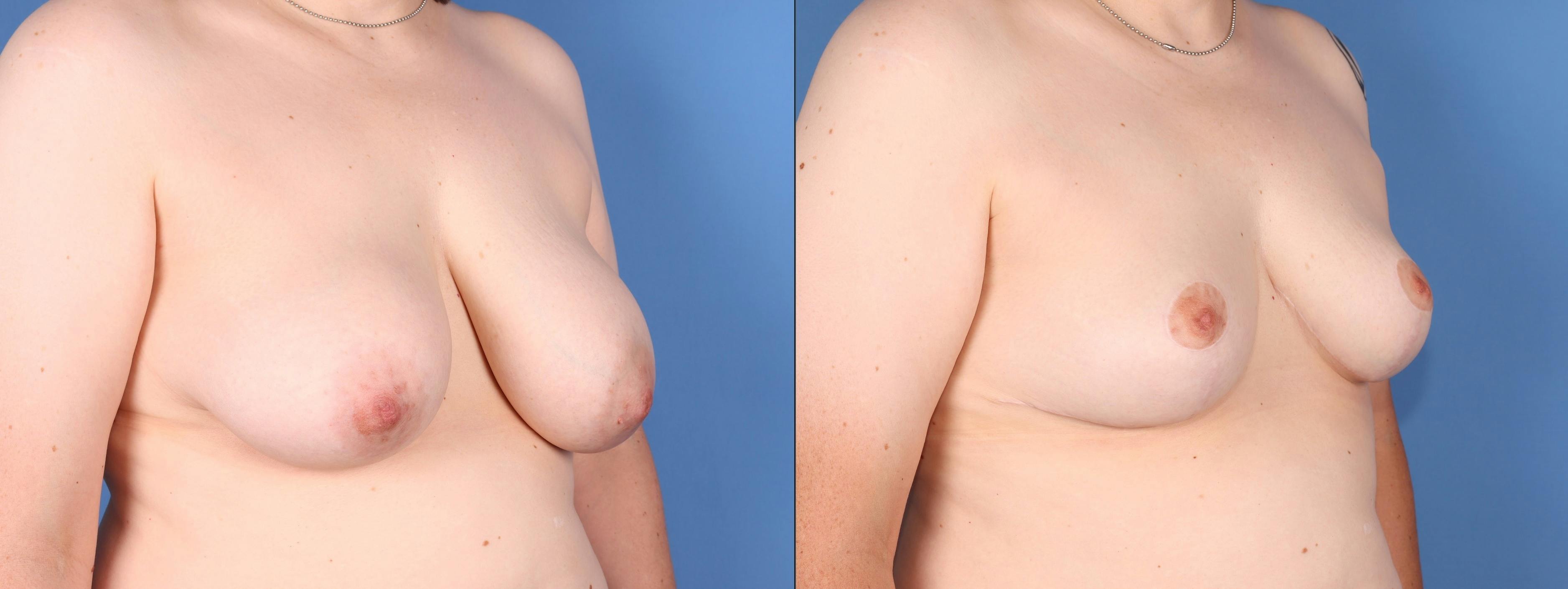 Breast Reduction Before & After Gallery - Patient 165467897 - Image 2