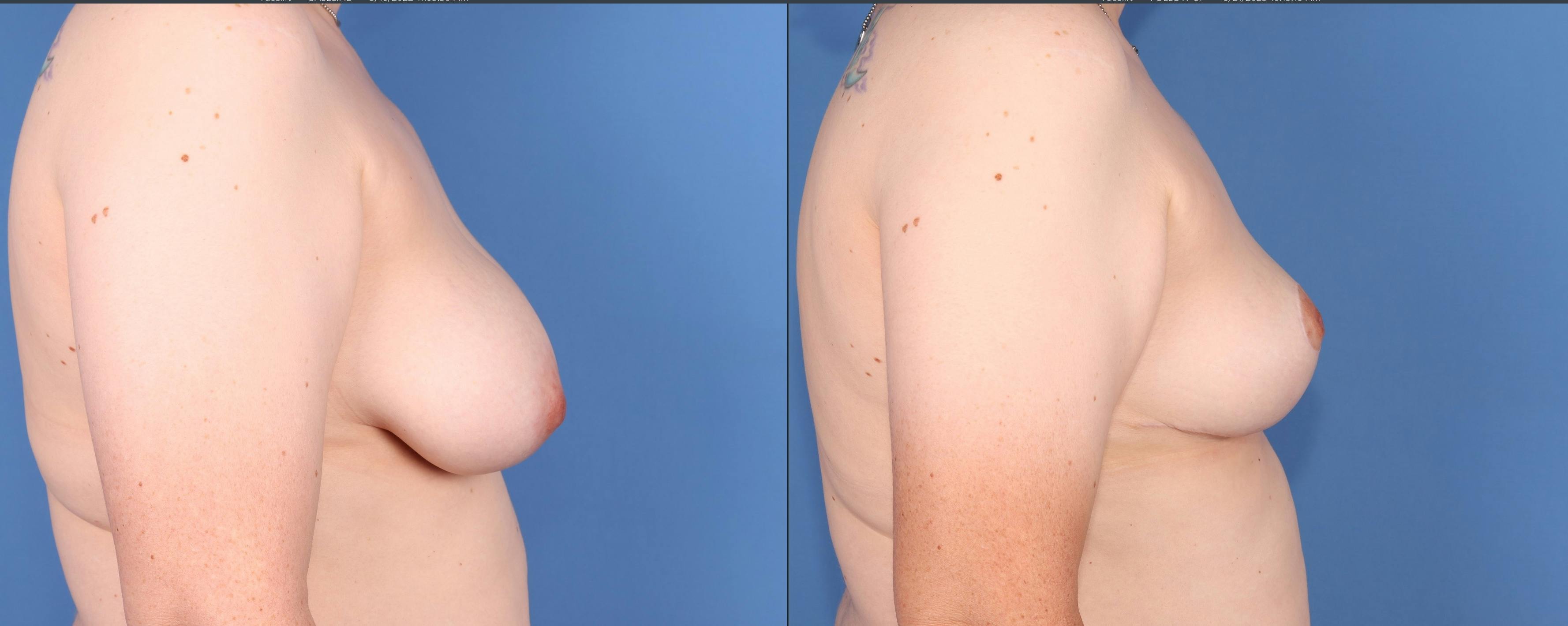 Breast Reduction Before & After Gallery - Patient 165467897 - Image 3