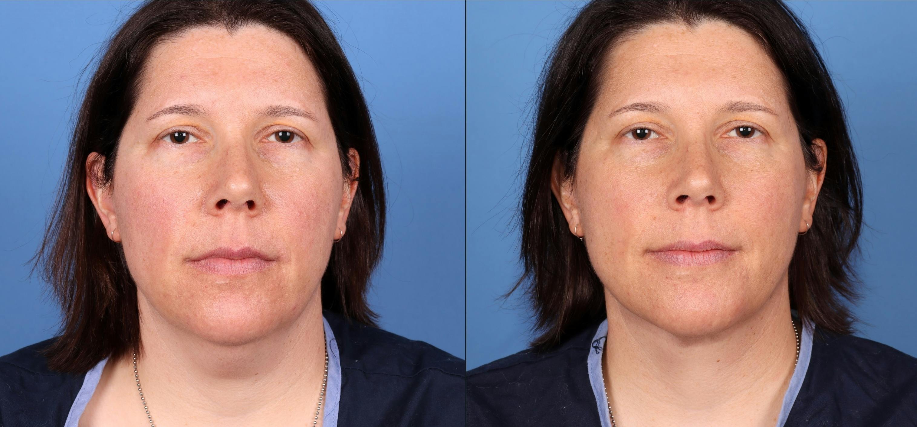 Face & Neck Before & After Gallery - Patient 165467910 - Image 1