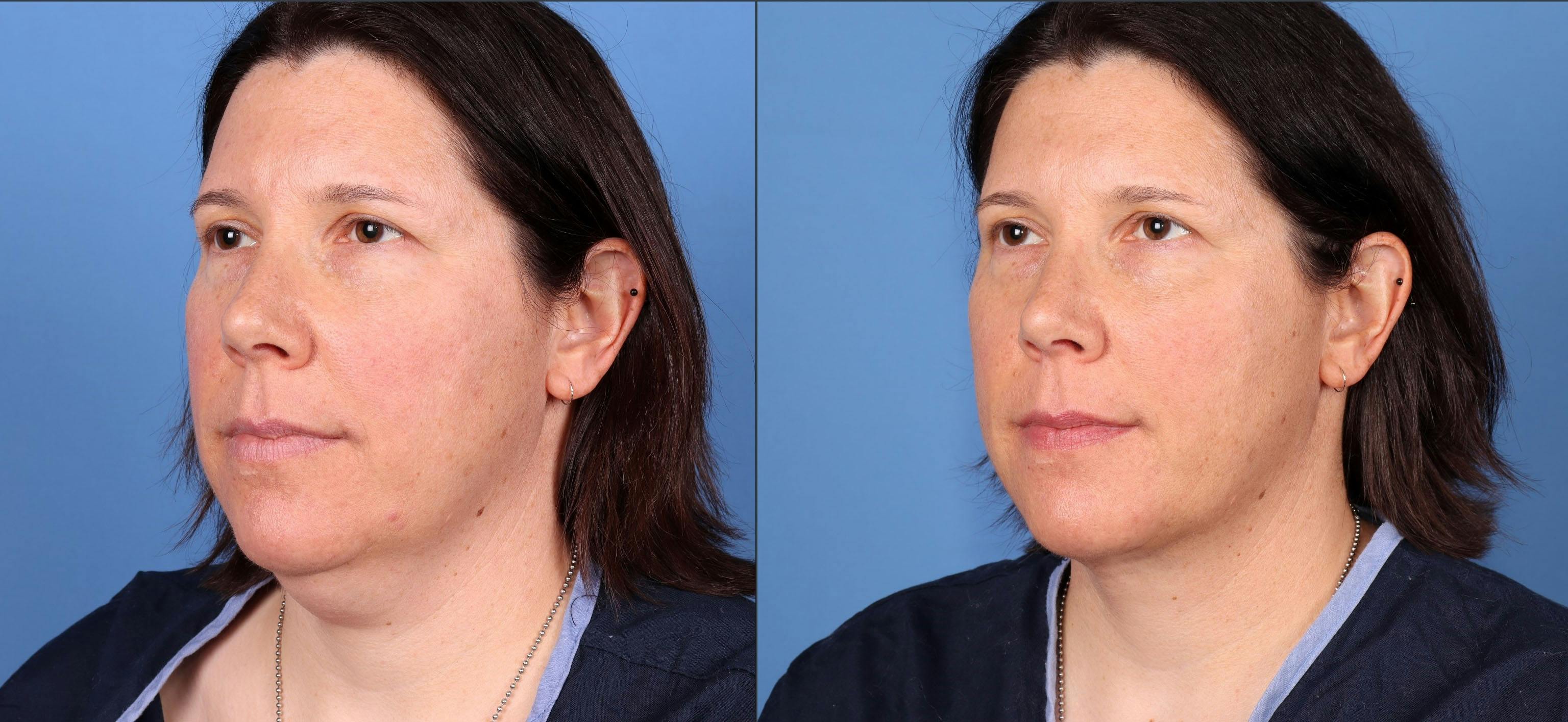 Face & Neck Before & After Gallery - Patient 165467910 - Image 2