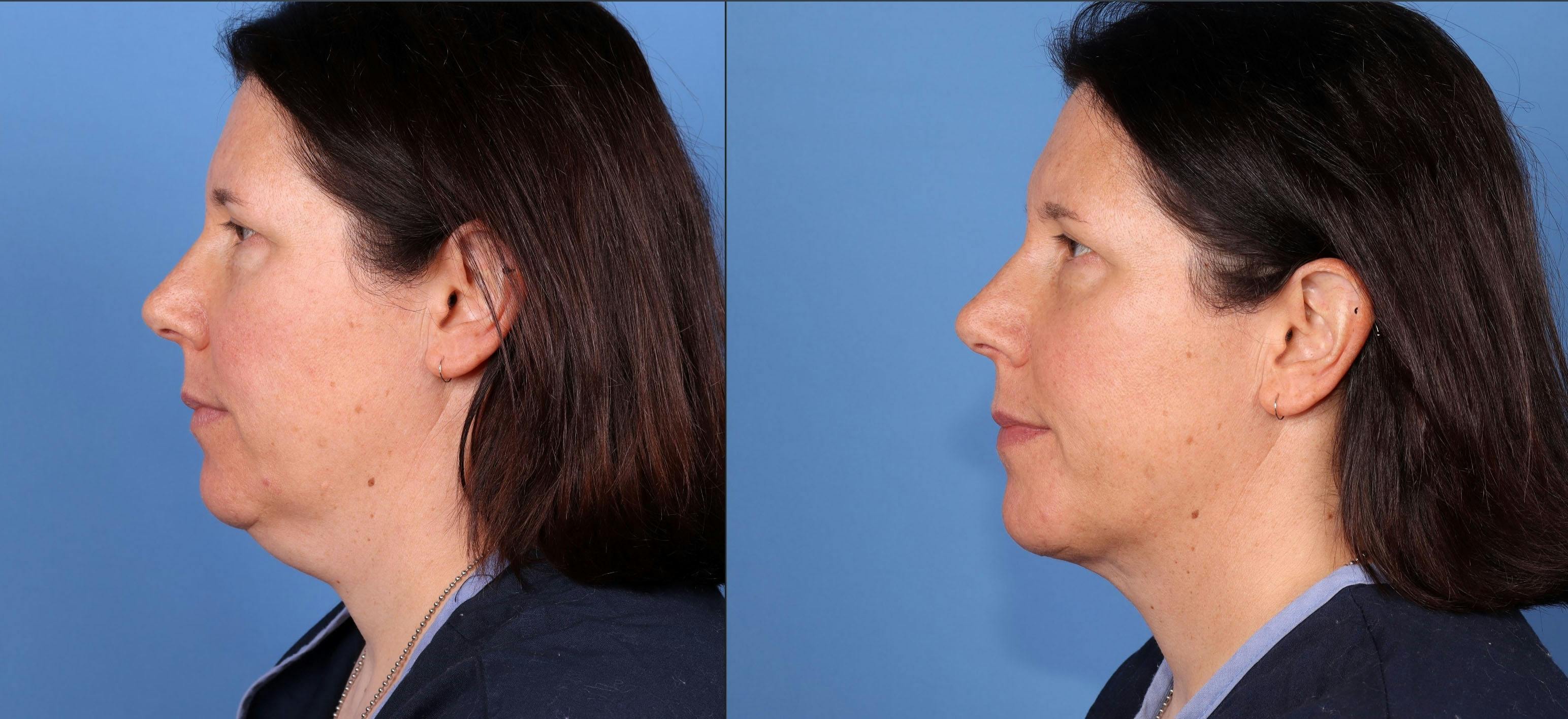 Face Before & After Gallery - Patient 165467910 - Image 3