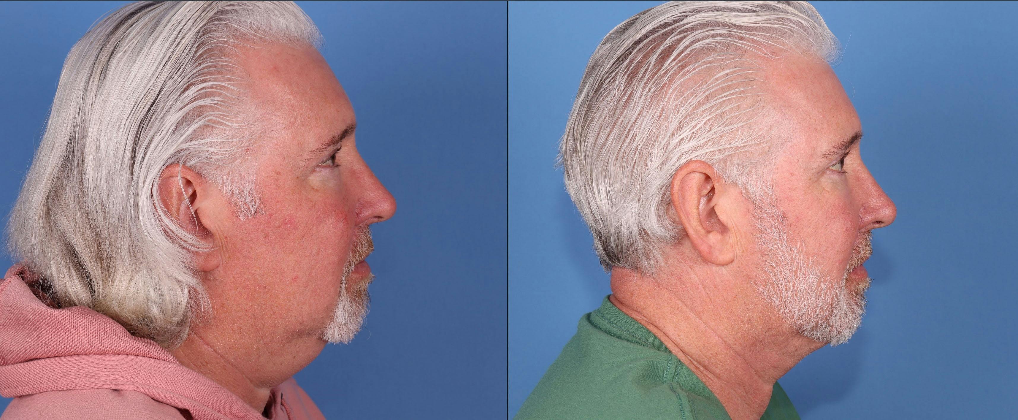 Neck Lift Before & After Gallery - Patient 167805897 - Image 3