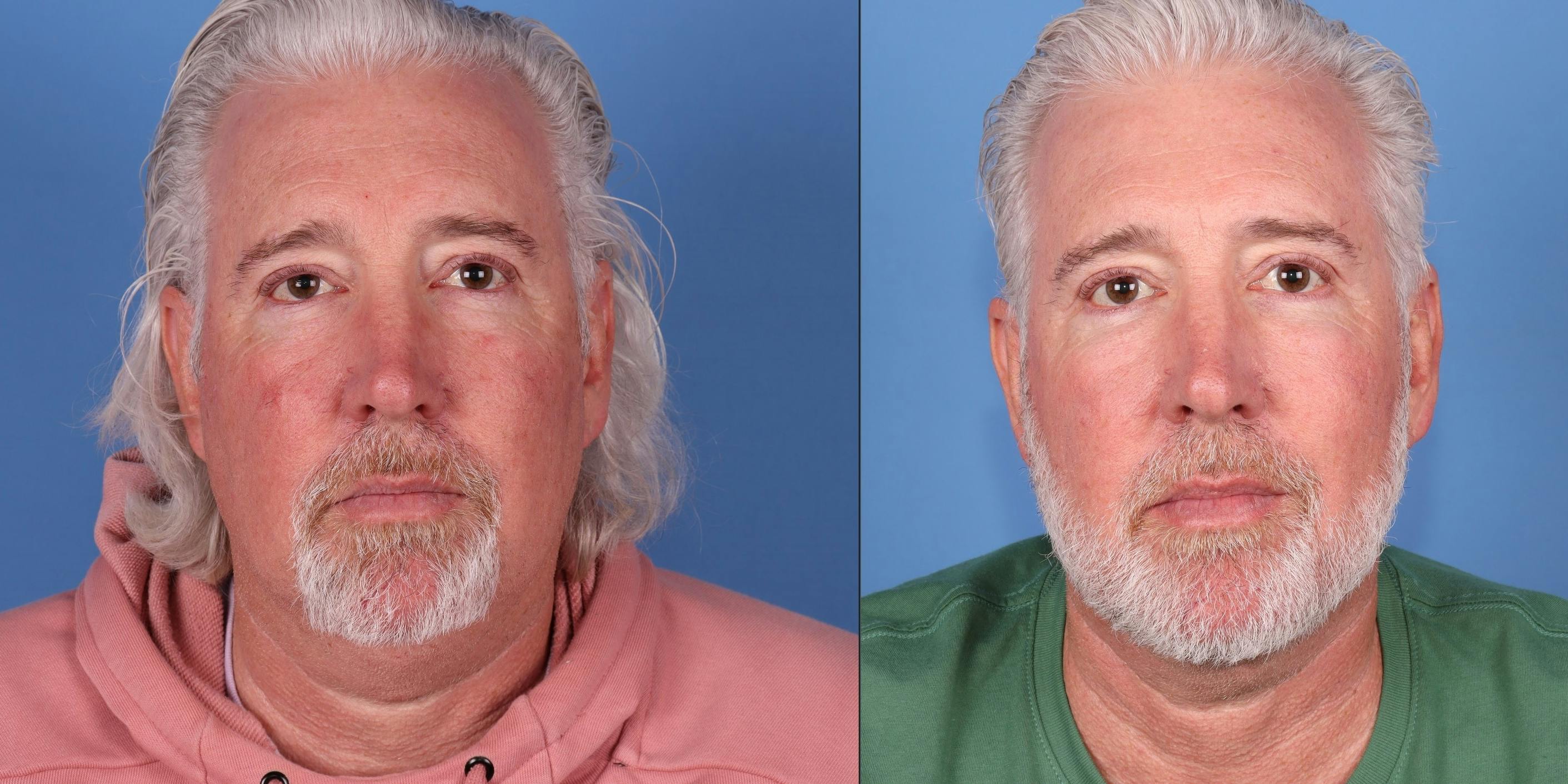 Neck Lift Before & After Gallery - Patient 167805897 - Image 1