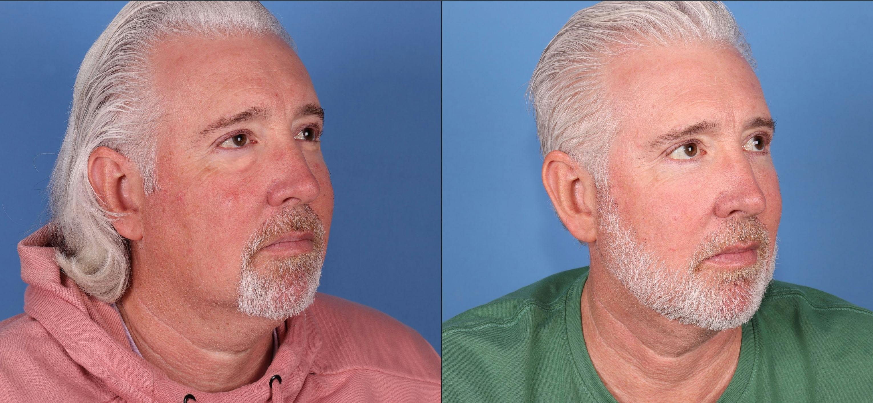 Neck Lift Before & After Gallery - Patient 167805897 - Image 3