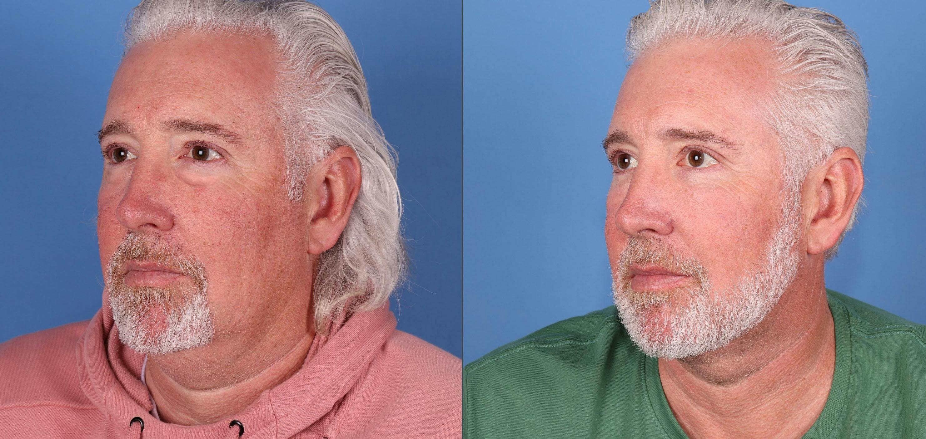 Neck Lift Before & After Gallery - Patient 167805897 - Image 4