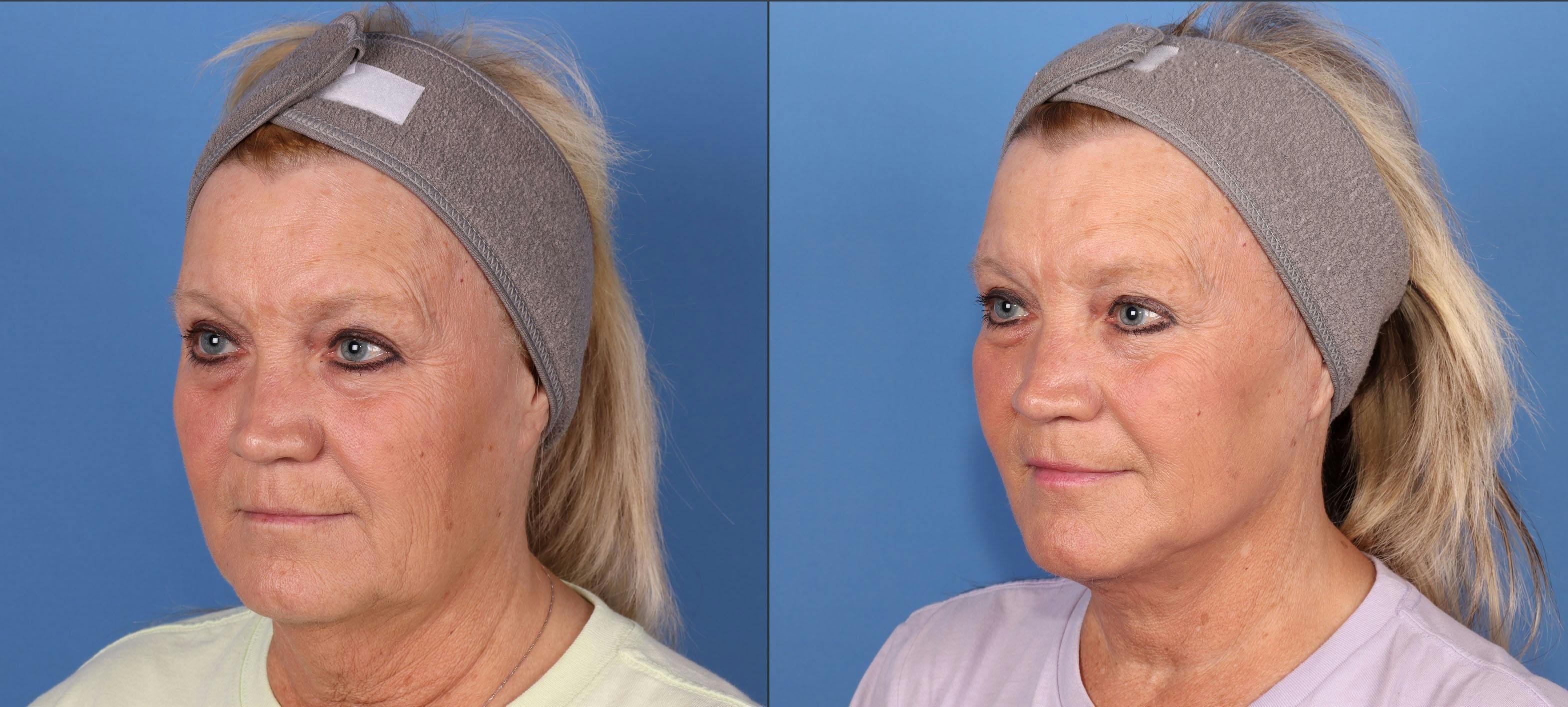 Mini Facelift Before & After Gallery - Patient 167806124 - Image 1