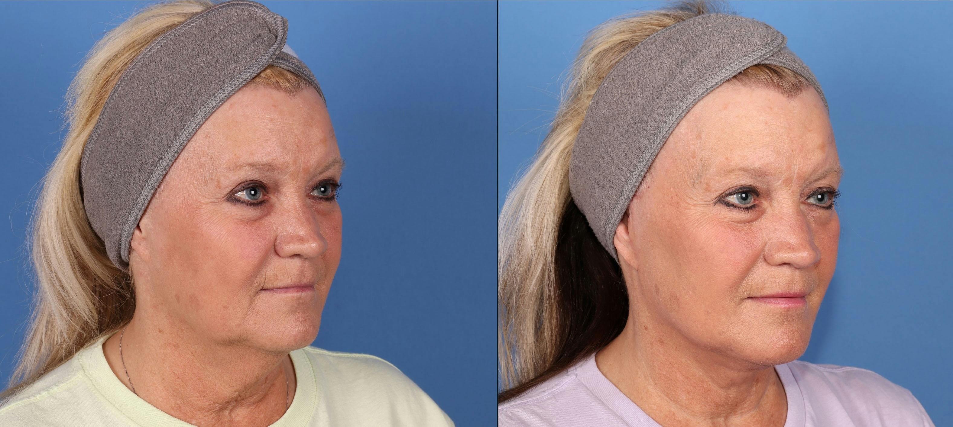 Mini Facelift Before & After Gallery - Patient 167806124 - Image 2