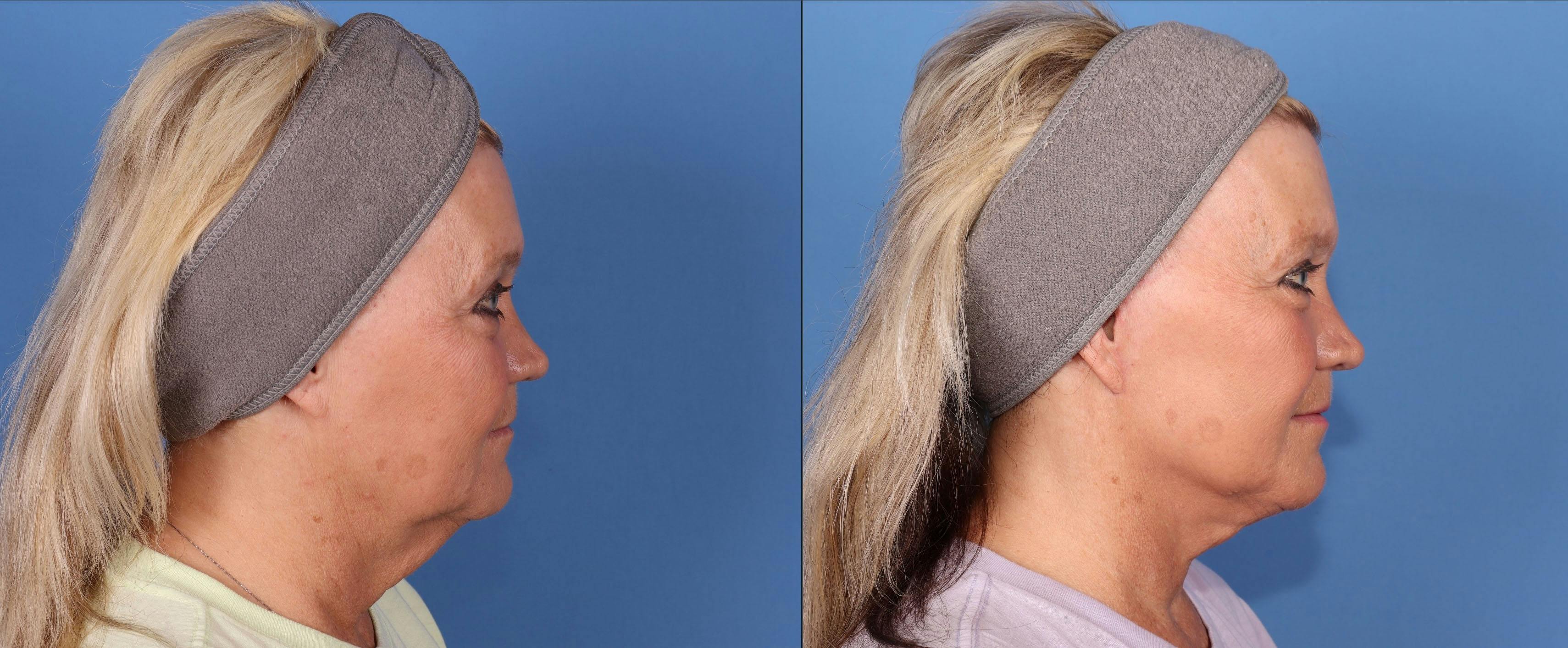 Mini Facelift Before & After Gallery - Patient 167806124 - Image 3