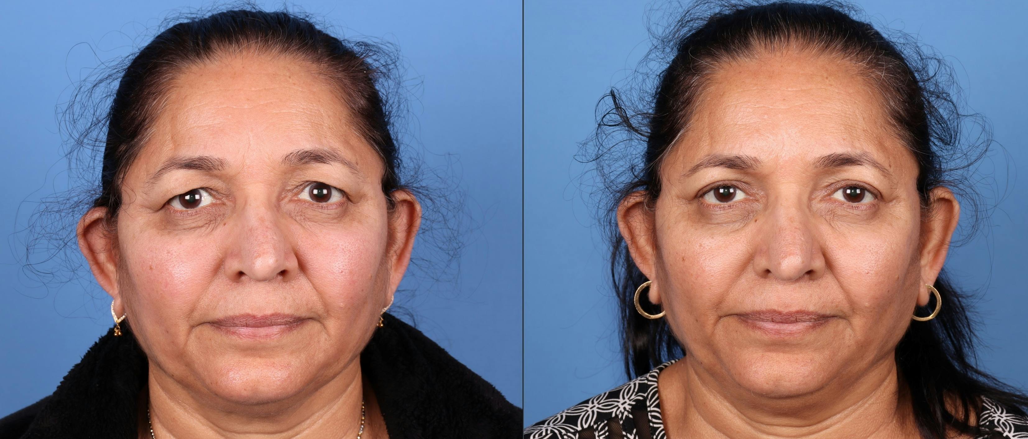 Eyelid Surgery (Upper Blepharoplasty) Before & After Gallery - Patient 168486115 - Image 1