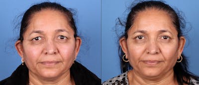 Eyelid Surgery (Upper Blepharoplasty) Before & After Gallery - Patient 168486115 - Image 1