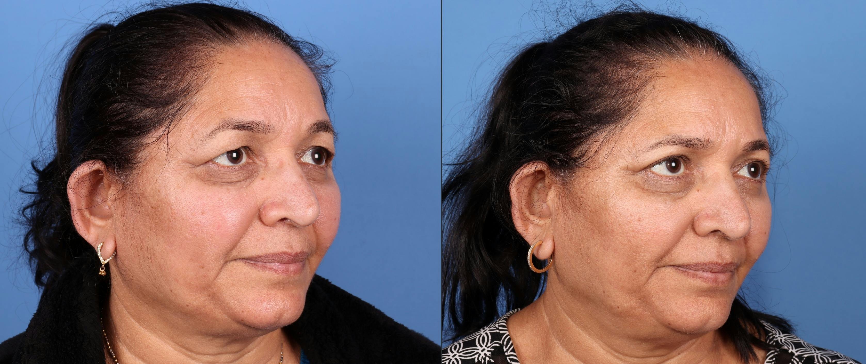 Eyelid Surgery (Blepharoplasty) Before & After Gallery - Patient 168486115 - Image 2