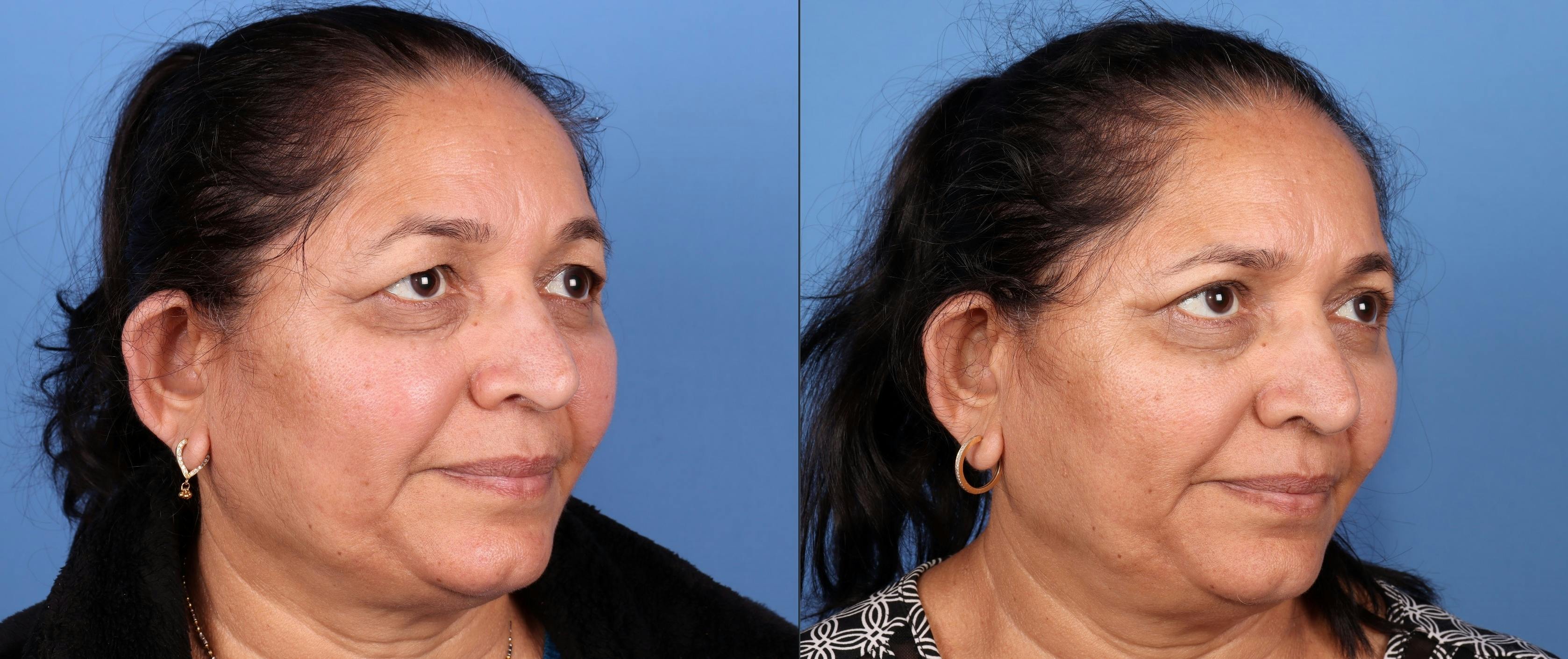 Eyelid Surgery (Upper Blepharoplasty) Before & After Gallery - Patient 168486115 - Image 2