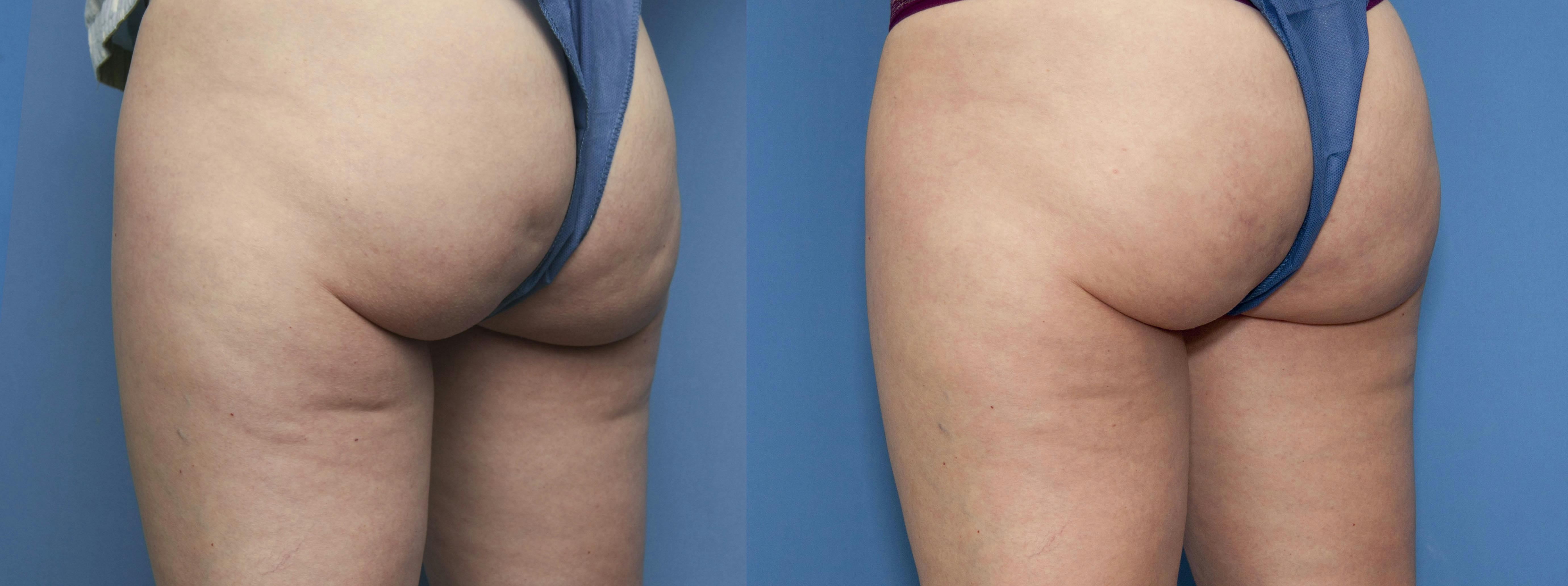 Aveli Before & After Gallery - Patient 168486706 - Image 2