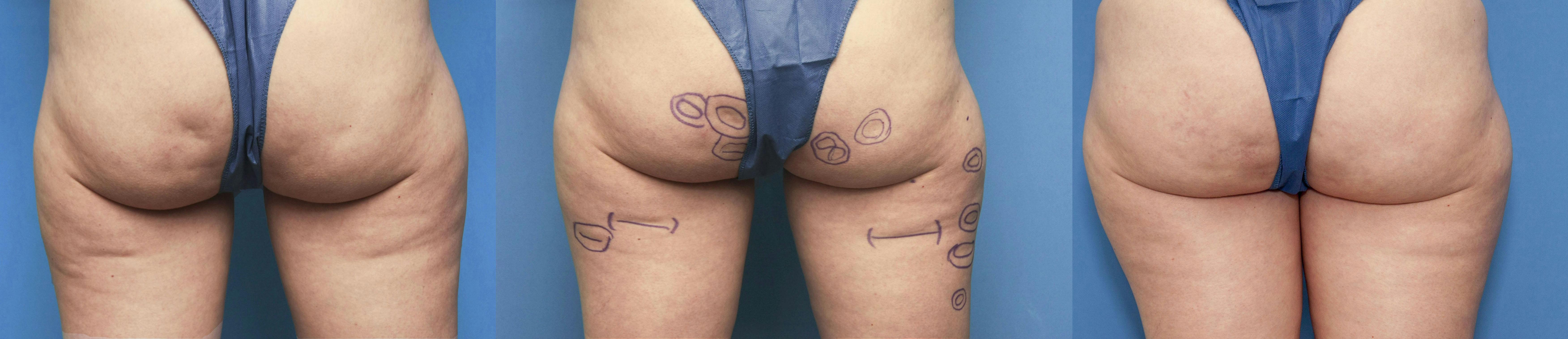 Aveli Before & After Gallery - Patient 168486706 - Image 3