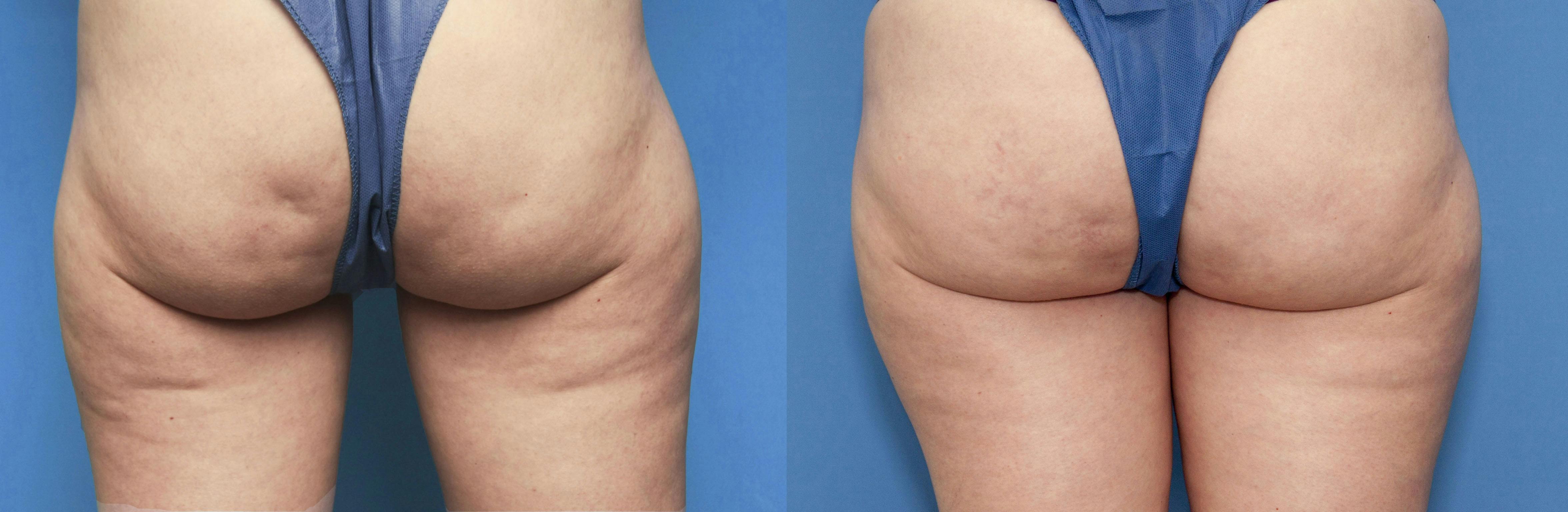 Cellulite Reduction