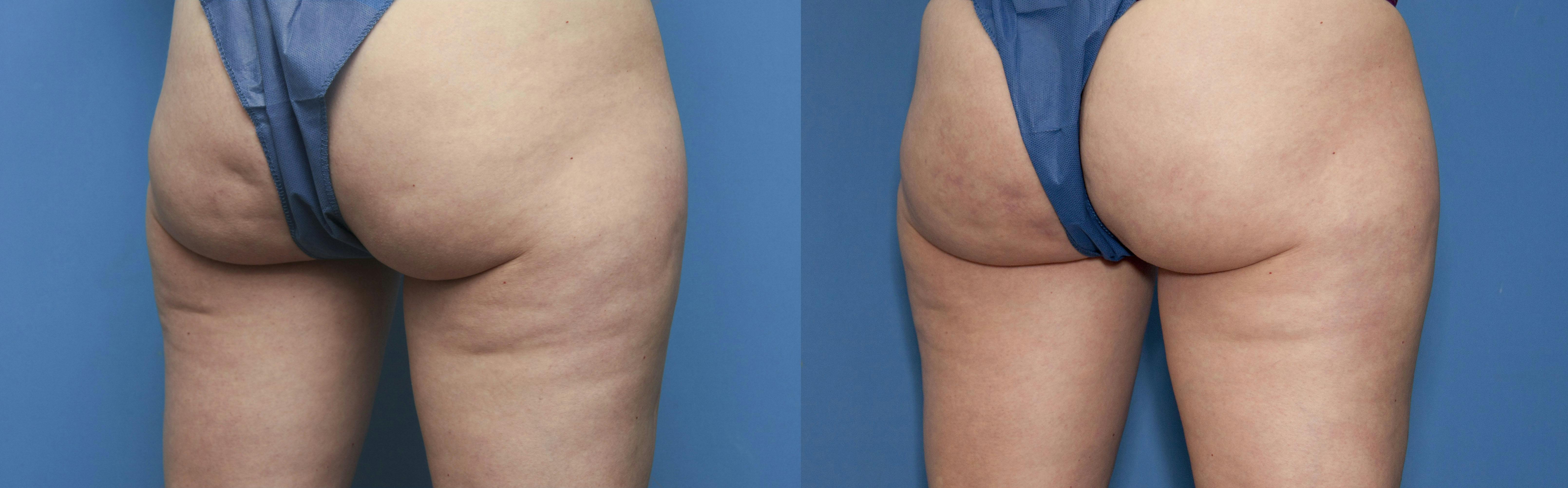 Aveli Before & After Gallery - Patient 168486706 - Image 5
