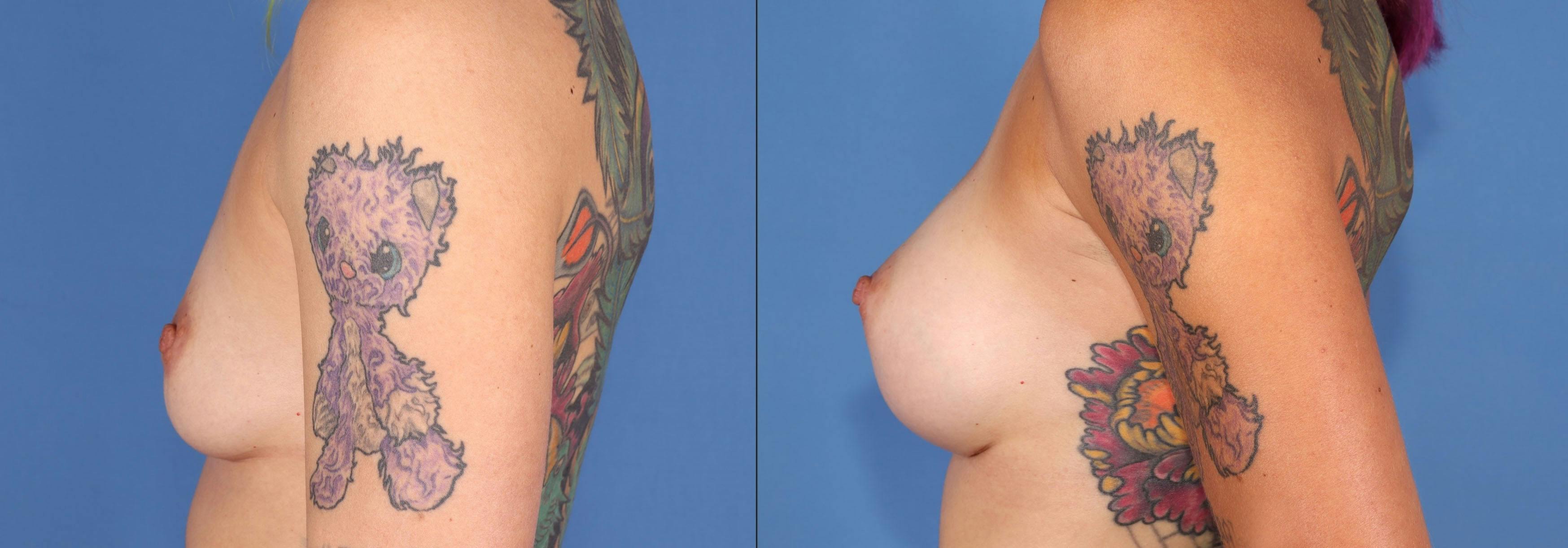 Breast Augmentation Before & After Gallery - Patient 174022096 - Image 3