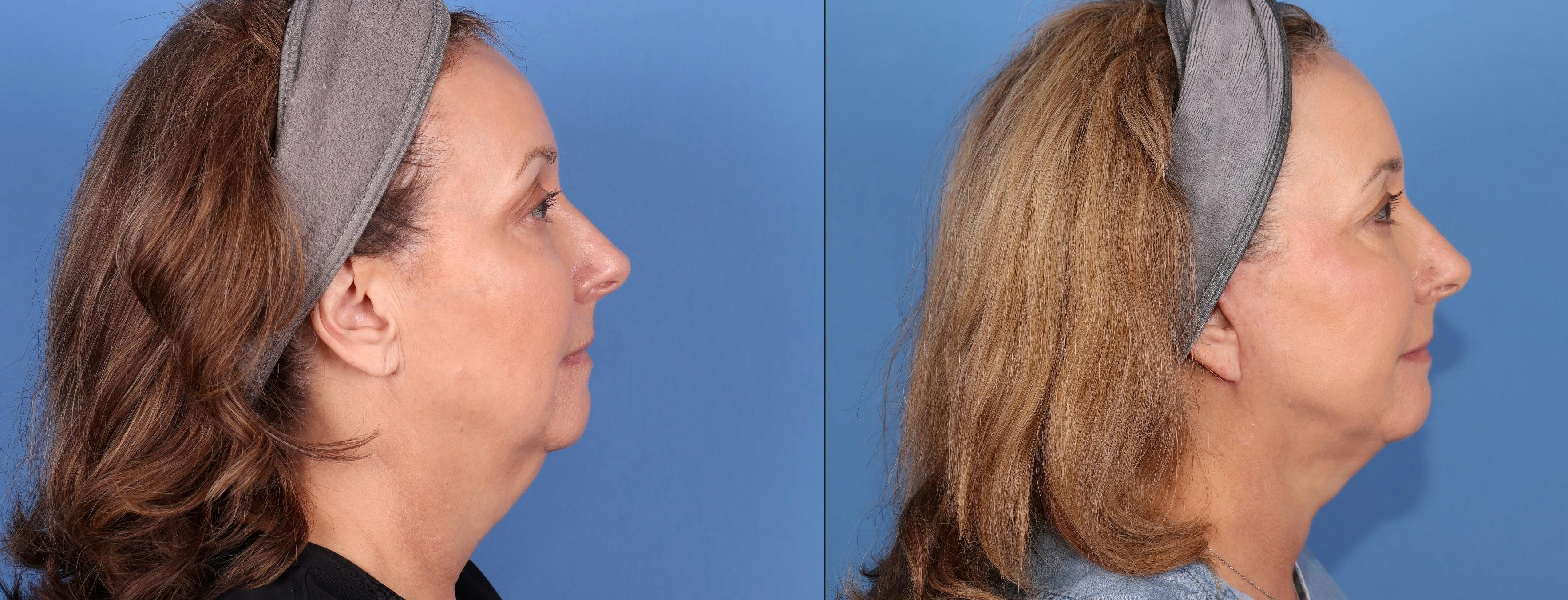 Mini Facelift Before & After Gallery - Patient 174425155 - Image 2