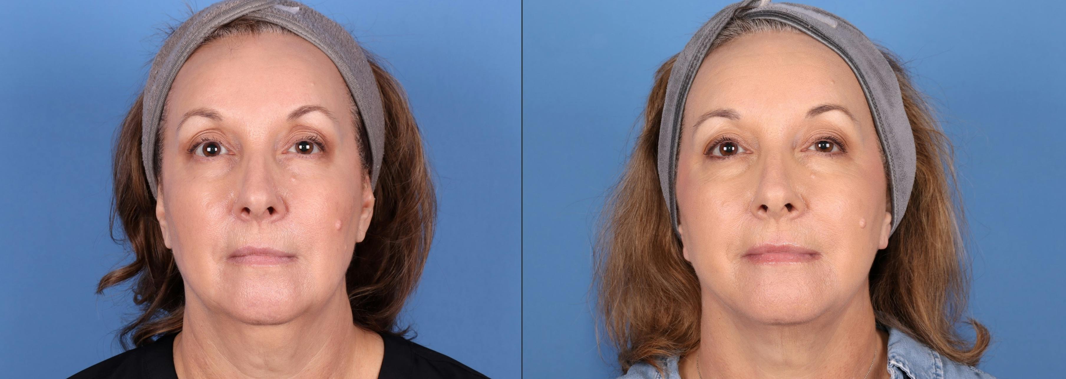 Mini Facelift Before & After Gallery - Patient 174425155 - Image 3