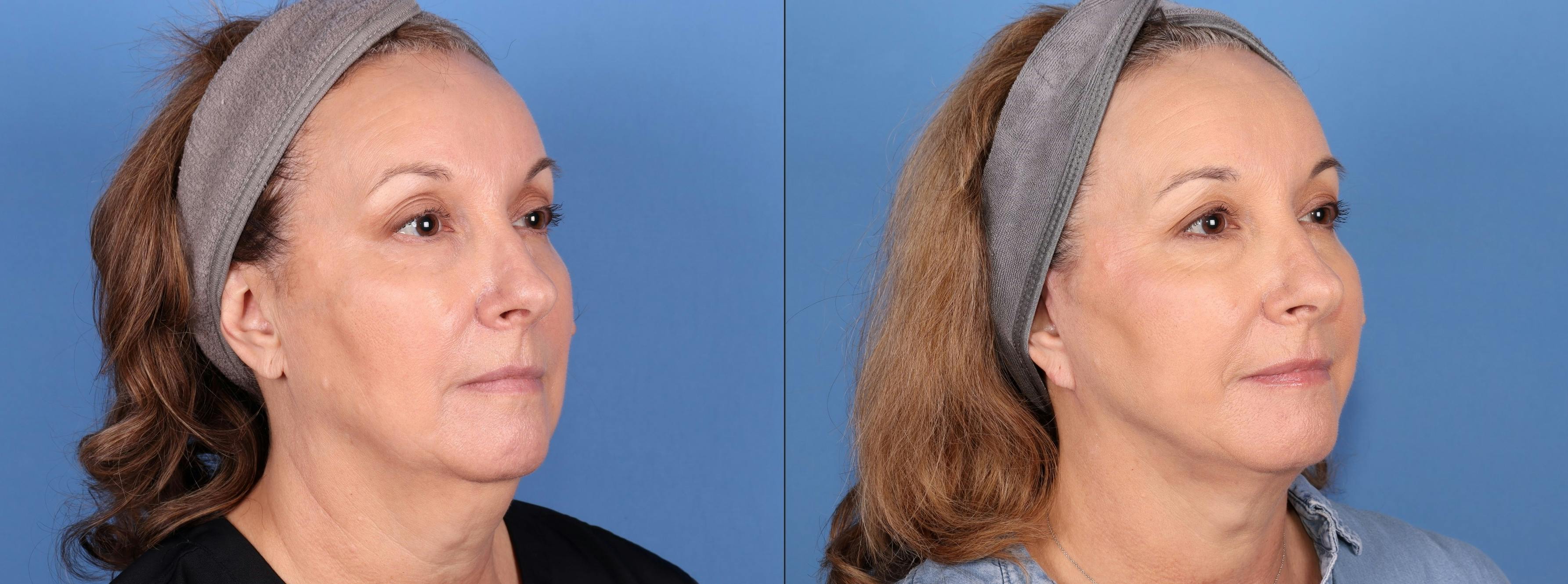 Face Before & After Gallery - Patient 174425356 - Image 2
