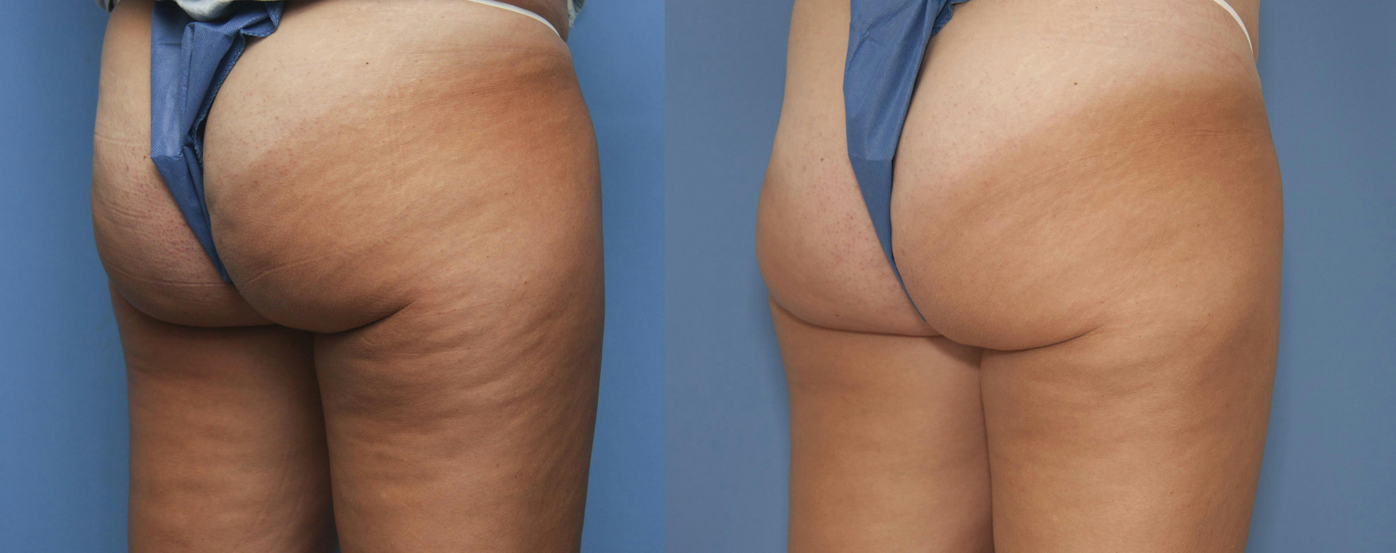Aveli Before & After Gallery - Patient 175186507 - Image 2