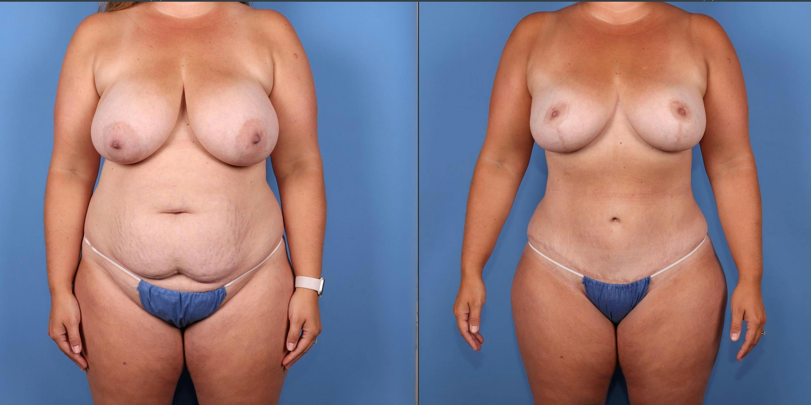 Mommy Makeover Before & After Gallery - Patient 176985357 - Image 1
