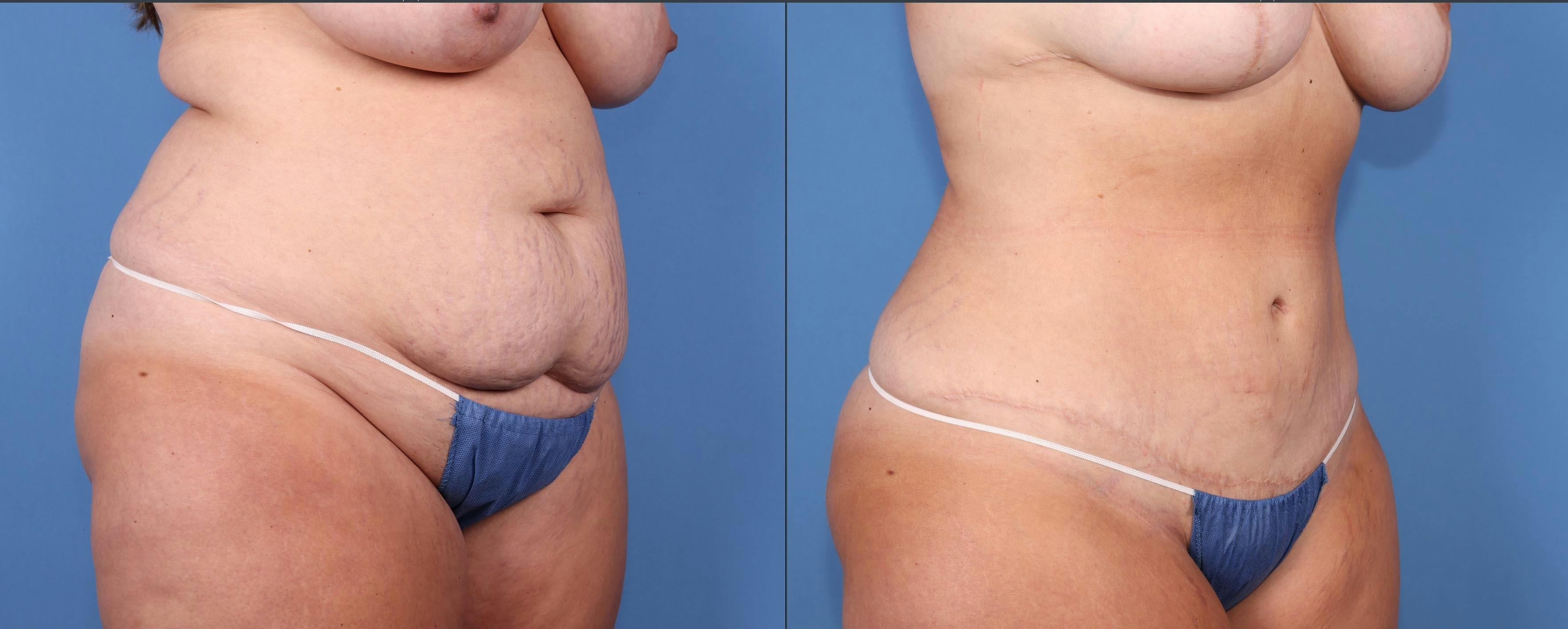 Abdomen Before & After Gallery - Patient 176985713 - Image 2