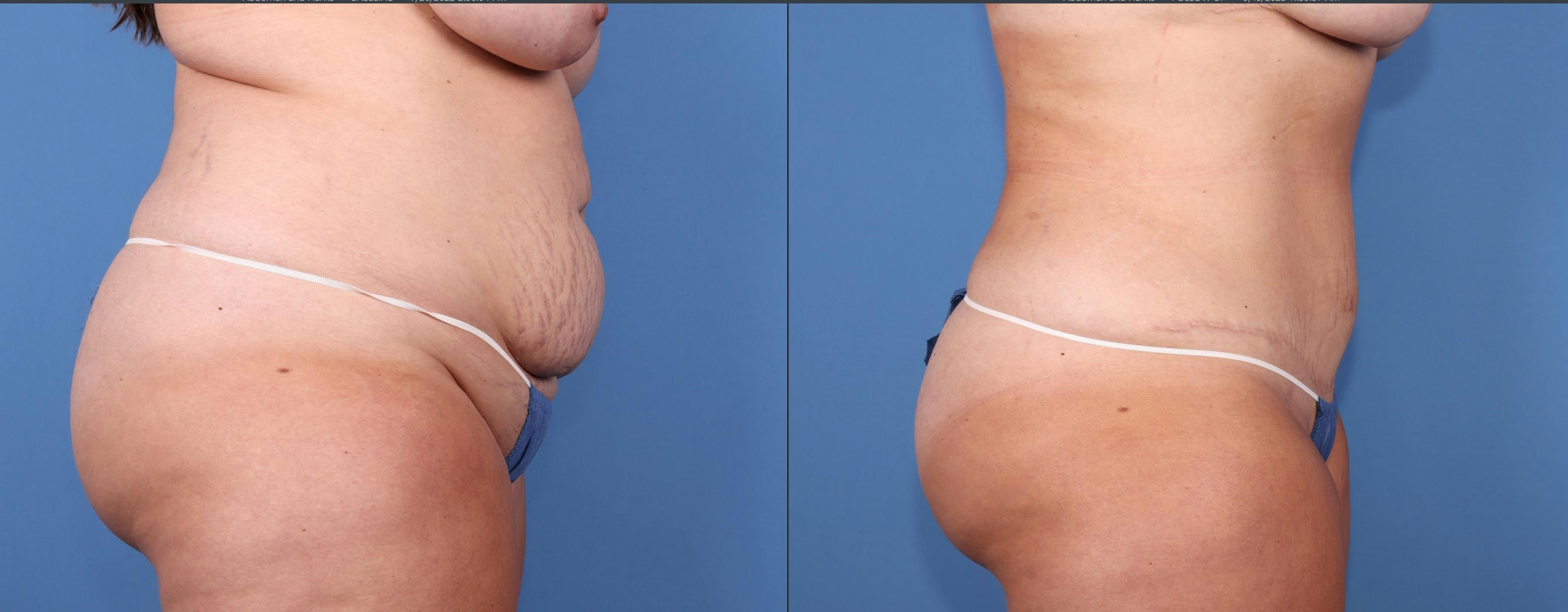Abdomen Before & After Gallery - Patient 176985713 - Image 3
