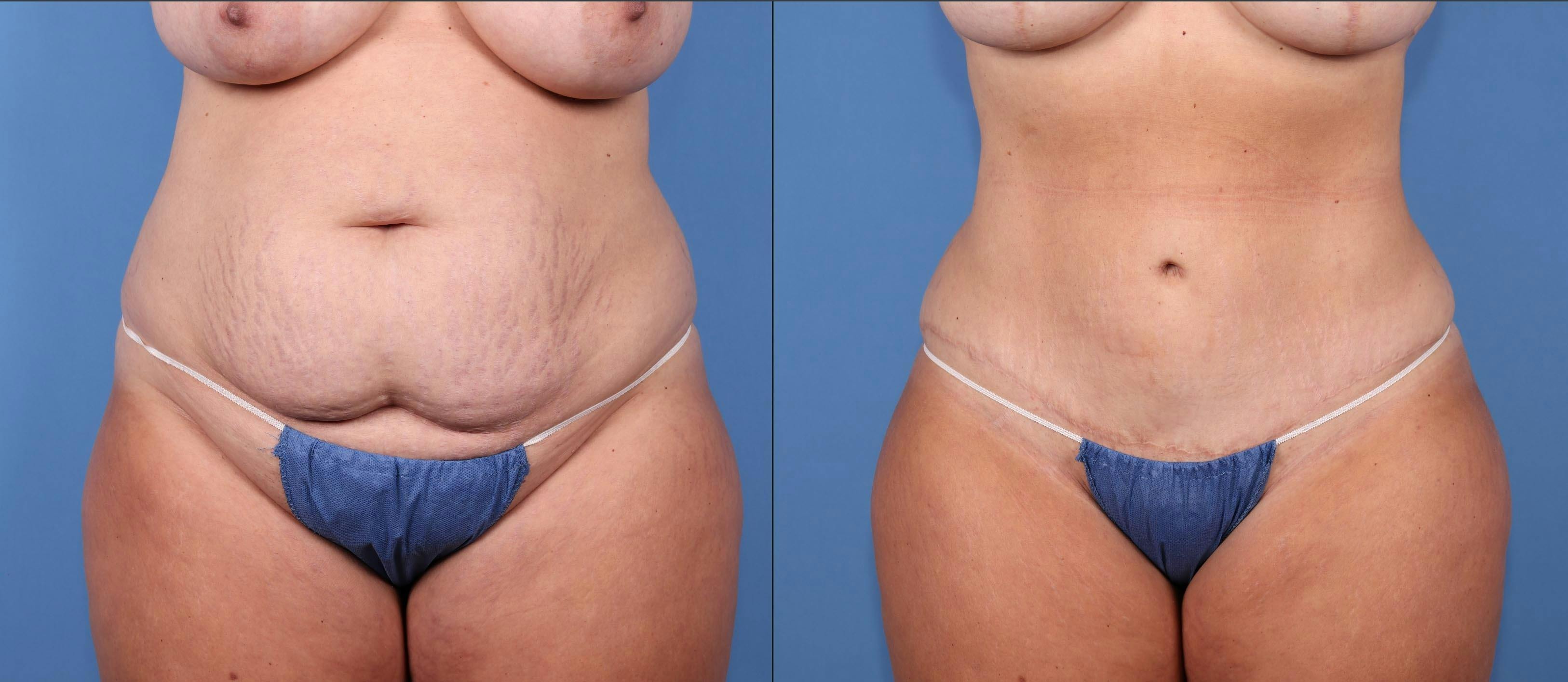 Tummy Tuck Before & After Gallery - Patient 176985843 - Image 1