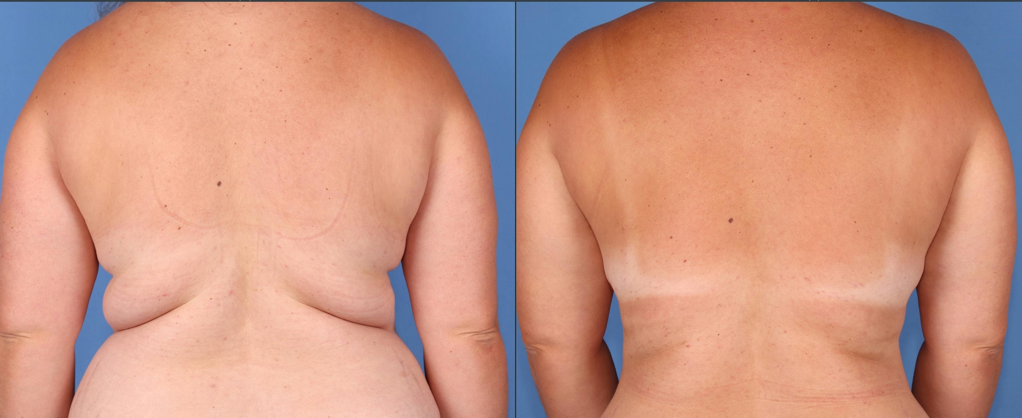 Abdomen Before & After Gallery - Patient 176985713 - Image 6